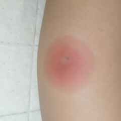 Fototapeta premium Safe and Effective Ligelizumab Treatment for Chronic Spontaneous Urticaria