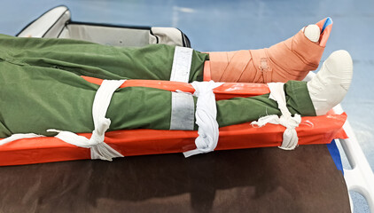 splinting a patient's leg with a broken leg using a wooden splint