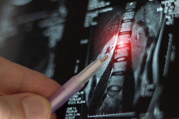 Doctor learn MRI or CT image for diagnostic spine trauma. Close up view.