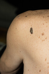 Fototapeta premium Brown spots and freckles on the back of an old man. Skin problems.