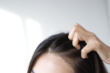 Fototapeta premium A woman has problems with hair and scalp,she has dandruff from allergic reactions to shampoos. and hair conditioner