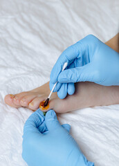 A doctor applies iodine to the damaged nail of a woman's little finger.