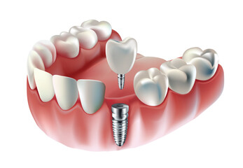 Tooth implant, tooth restoration, on white background, Vector illustration
