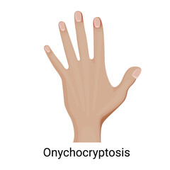 Onychocryptosis on the hand vector illustration.