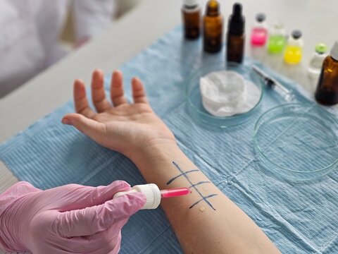 Demonstration of skin allergy testing procedure in clinic