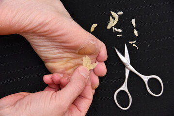 Man cuts rough scissors, calluses, corns on the soles. Foot care at home © Kryuchka Yaroslav