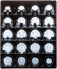 Brain scan image on Magnetic Resonance Imaging (MRI) film of elderly patient for neurological medical diagnosis on brain disease