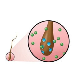 Male Pattern Hair Loss Follicle