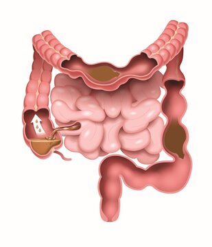 Illustration of Large Intestine Showing Irritable Bowel Syndrome with Constipation