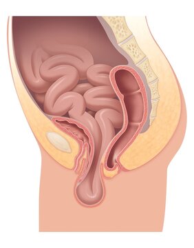Illustration showing pelvic organs with intestinal prolapse in female anatomy (enterocele prolapse)