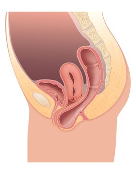 Illustration showing pelvic organs with rectal prolapse in female anatomy (rectocele prolapse)