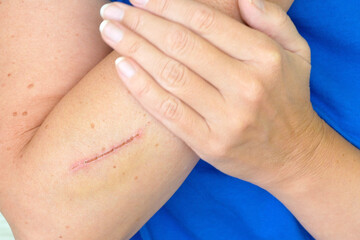 Treating a deep cut on the hand  Scar on hand. Cut and wound in the skin..