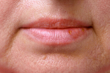 Fototapeta premium stomatitis in mouth closeup, close-up on the lip with aphthous stomatitis, treatment of inflammation of the oral mucosa