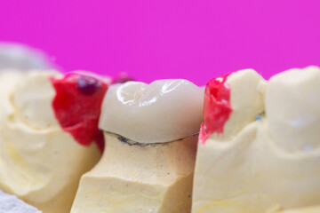 Metal-ceramic dental crown is tried