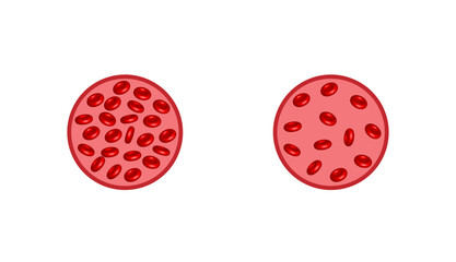 Iron deficiency anemia. The difference of Anemia amount of red blood cells and normal. Blood donation. Realistic vector 3d picture. Vector illustration isolated on white background.