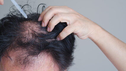 A man is dripping with pipette a hair nourishing serum on a thinning head area.