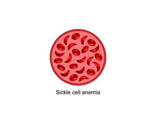Sickle cell anemia. Vector illustration isolated on white background.