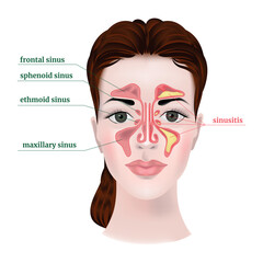 The face of a girl with the anatomy of the maxillary sinuses, with a description. The disease is sinusitis. Medical poster, infographics
