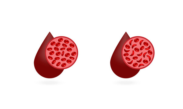 Sickle cell anemia. Normal red blood cells and sickle cells. Vector illustration isolated on white background.	