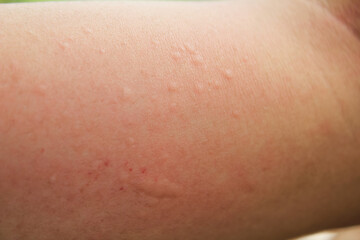 Fototapeta premium Allergy Skin rash appears red and itchy on the man's arm