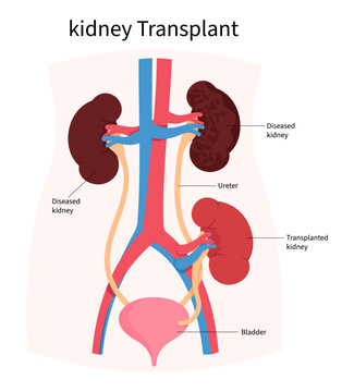 Kidney transplantation for end stage renal failure