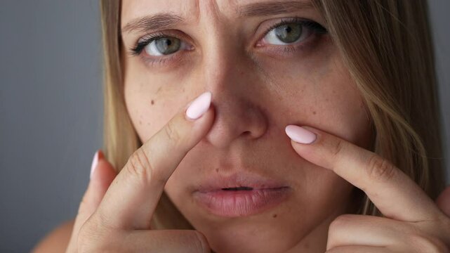 Young blonde woman with blackheads on her nose on a dark grey background. A girl showing black dots with her hands. Acne problem, comedones. Enlarged pores on the face. Cosmetology dermatology concept
