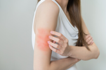 Dermatology asian young woman, girl allergy, allergic reaction from atopic, insect bites on her arm, hand in scratching itchy, itch red spot or rash of skin. Healthcare, treatment of beauty.