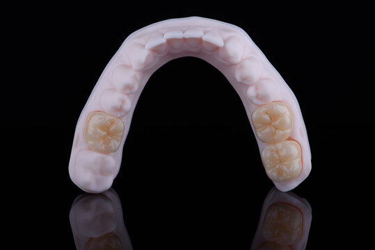 High-quality naturally dental single crowns made of zirconium for fixation to the teeth of lower jaw