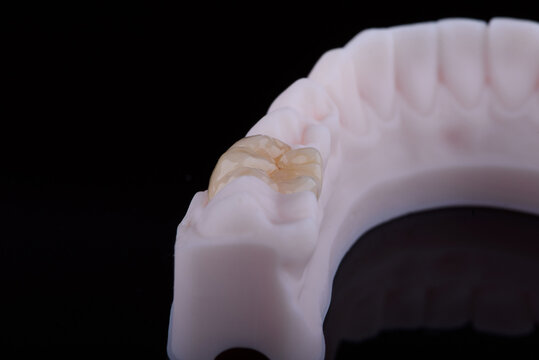 High-quality single dental crown with naturally morphology made of multilayer zirconia for lower jaw