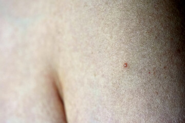 Fototapeta premium Folliculitis on human arm treatment.