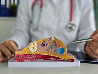 doctor explains disease and uses anatomical model of breast