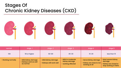 Stages of Chronic Kidney Disease (CKD) Infographic – Kidney Health Progression Chart