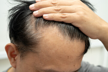 Obraz premium Bald head in man, hair loss treatment health problem.