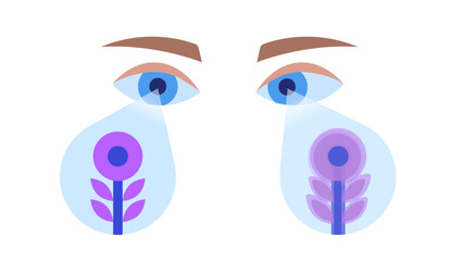 Amblyopia or lazy eye