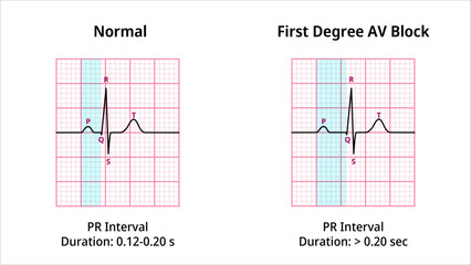 Comparison of AV Block Degree 1 and Normal ECG Waveforms - Medical Vector Illustration