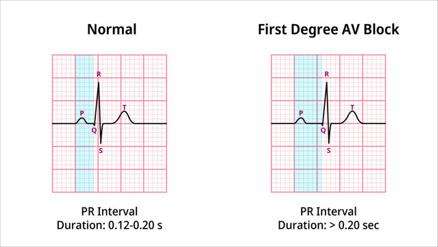 Comparison of AV Block Degree 1 and Normal ECG Waveforms - Medical Vector Illustration