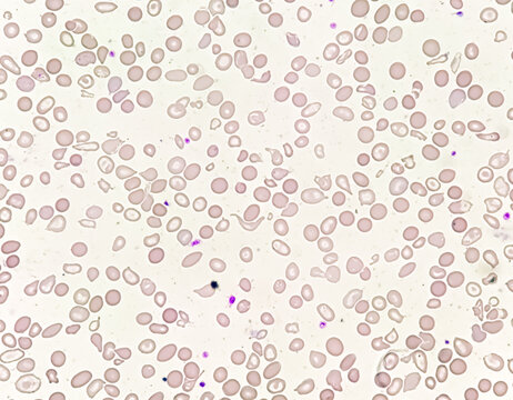 Hematological slide of Microscopic image showing severe microcytic hypochromic anemia. nRBC, Tear drop cell and others abnormal RBC present. 
