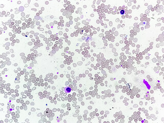 Hematological slide of Microscopic image showing severe microcytic hypochromic anemia. nRBC, Tear...