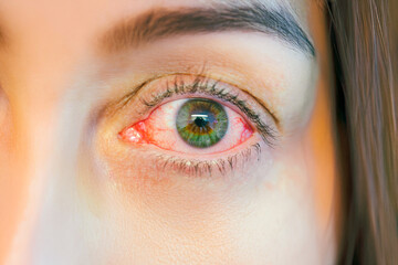 close up of female eye.. conjunctivitis eye