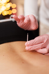 Acupuncture, needles and skin with hand in closeup, alternative medicine or healing therapy.