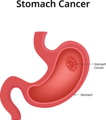 Stomach Cancer Science Vector Illustration
