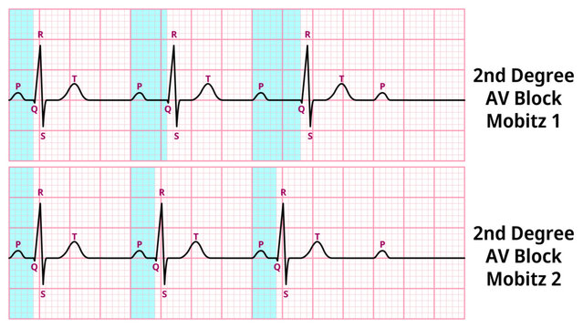 Comparison of AV Block Degree 2 Mobitz Type 1 and Type 2 ECG Waveforms - Medical Vector Illustration