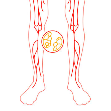 Vascular health. PAD early detection. Editable vector illustration.