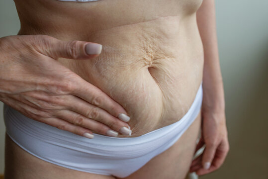 Mature woman applying body cream on abdomen with cilulite