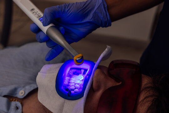 Dental Laser Whitening Procedure with Protective Glasses