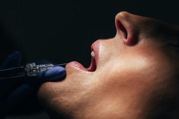 Close-up of dental anesthesia injection during a procedure