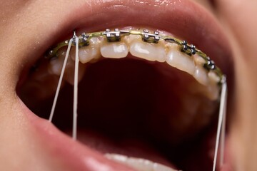Detailed closeup image of orthodontic braces with colorful rubber bands on the teeth
