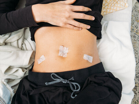 Woman Recovering from Laparoscopic Hysterectomy Surgery