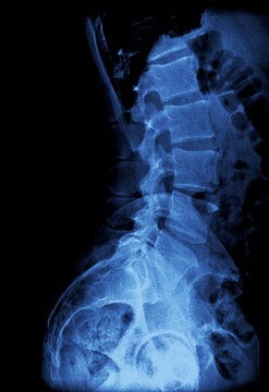 X-ray Image of the Lumbar Spine and Pelvic Area
