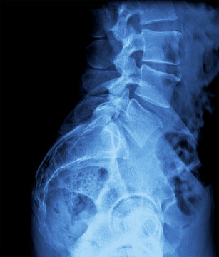 X-ray Image of the Lumbar Spine and Pelvic Area